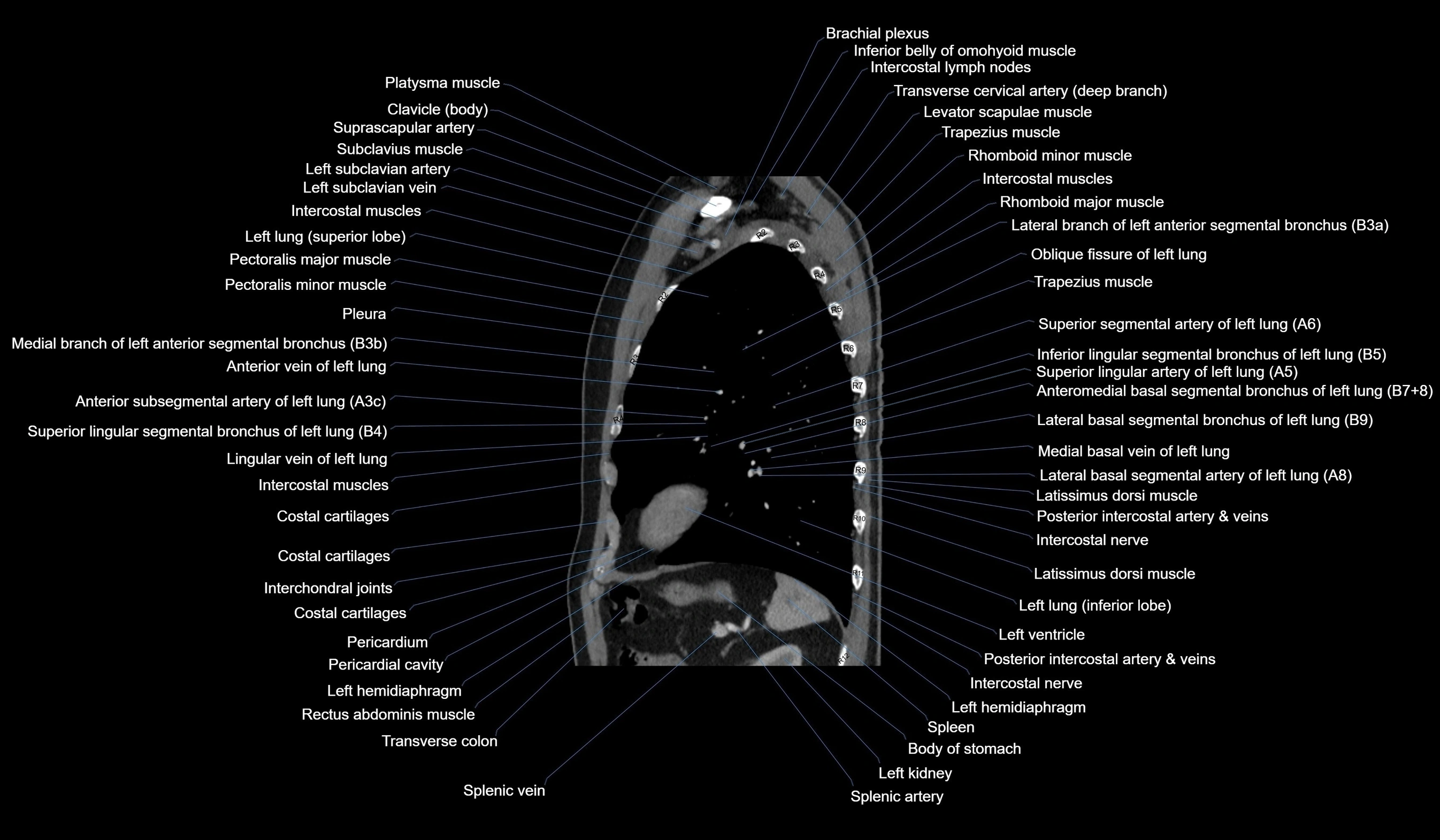 CT chest (thorax) labelled sagittal cross sectional anatomy radiology image-00103.webp